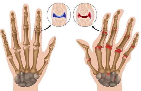 Arthritis disease and its manifestations