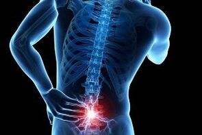 back pain in osteochondrosis