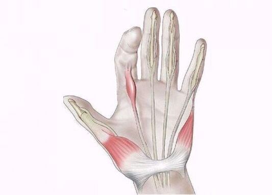 inflammation of the tendons as a cause of joint pain in the fingers