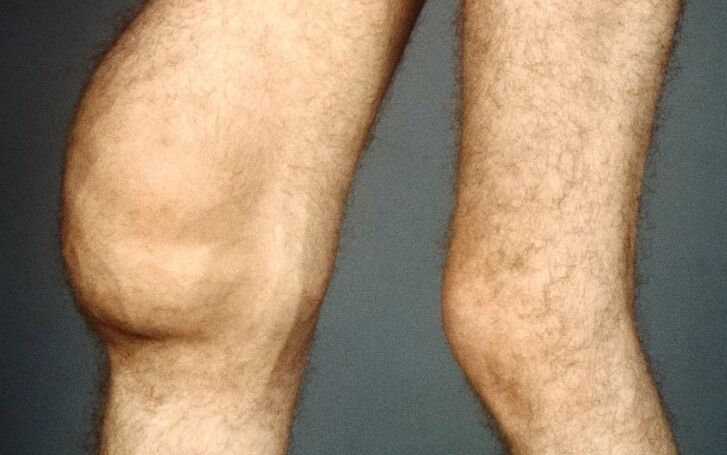The knee joint post -traumatic arthrosis