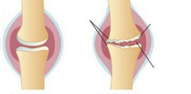 Cartilage