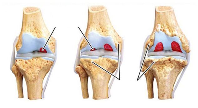 Joint complications of joints
