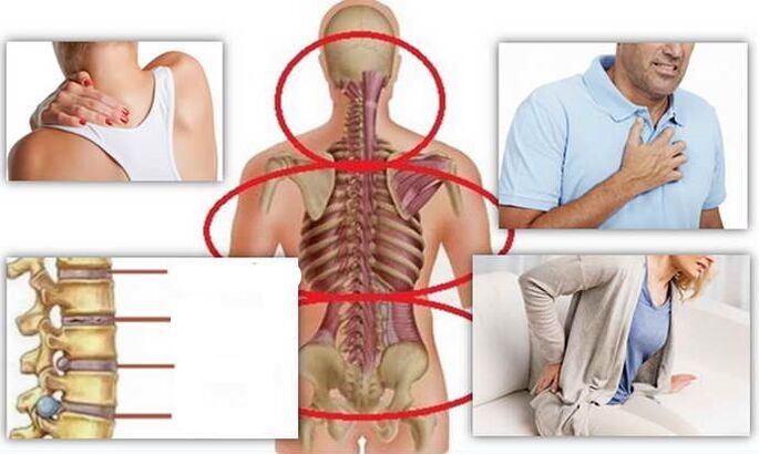 Disease for osteochondrosis