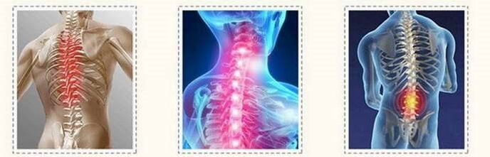 osteochondrosis spine lesions