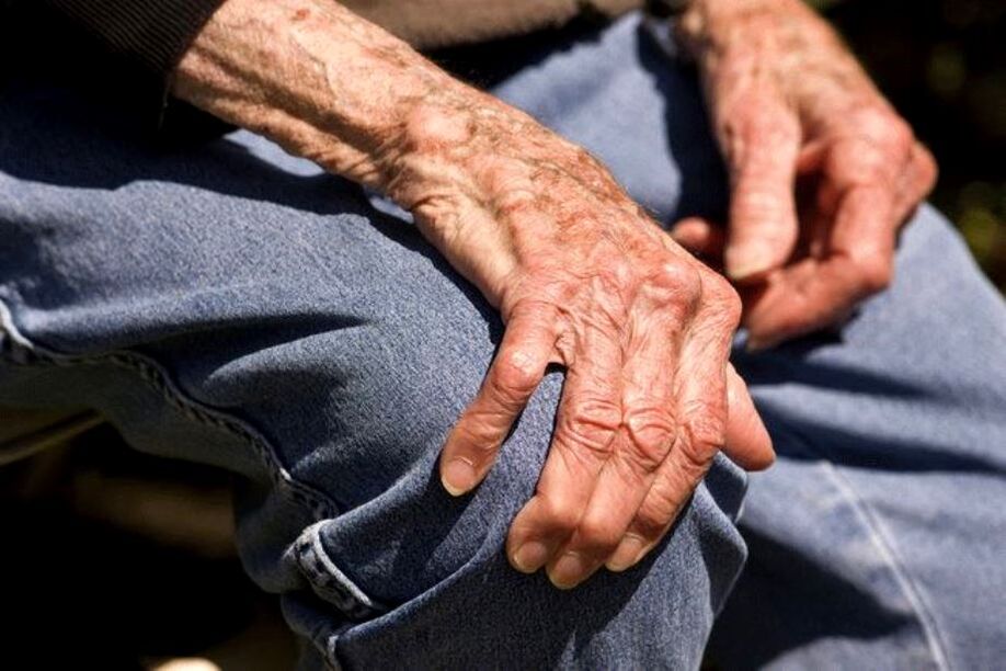 Arthrosis is an age-related disease that occurs in the elderly